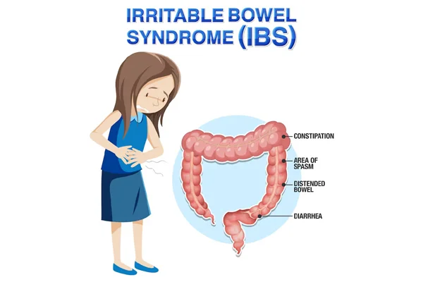 Irritable Bowel Disease