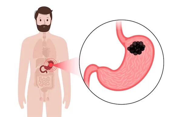 GI Cancer