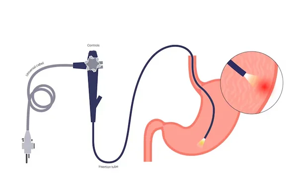 GI Endoscopic Procedures